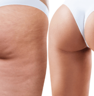Cellulite Reduction Service in chattanooga